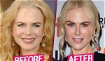 All About Nicole Kidman's Plastic Surgery: Enhancements and Procedures