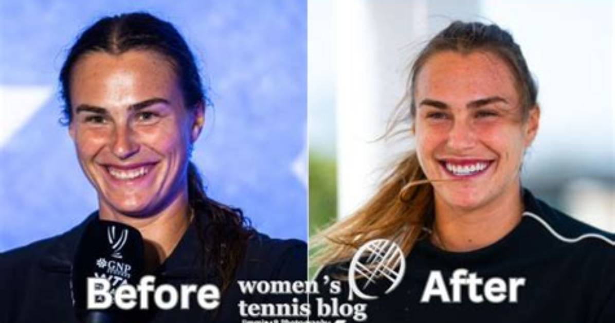 Aryna Sabalenka | Done Plastic Surgery? Before and After
