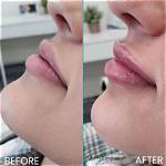 Before and After Photos Fans Suspect Lip Filler |