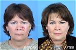 Before and After Plastic Surgery Photos Revealed ·