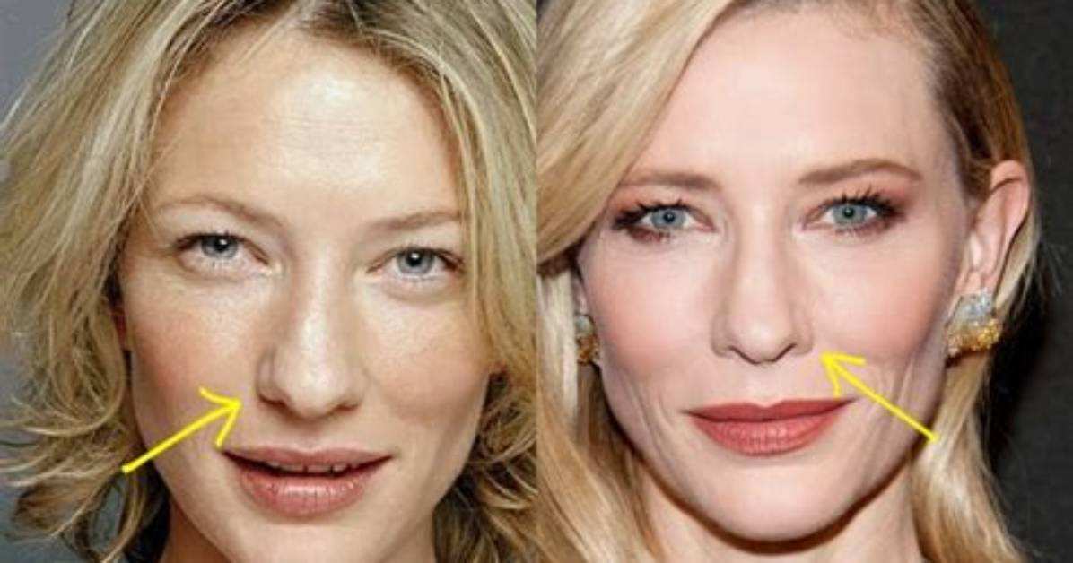 Cate Blanchett Plastic Surgery and Teeth Veneers Fake Tooth Photos