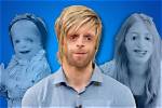 Celebrities with Treacher Collins Syndrome
