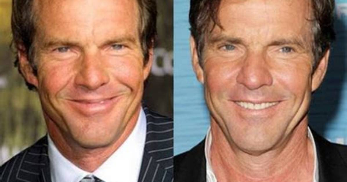 Dennis Quaid Plastic Surgery: Before & After! |