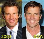 Dennis Quaid Plastic Surgery: Before & After! |