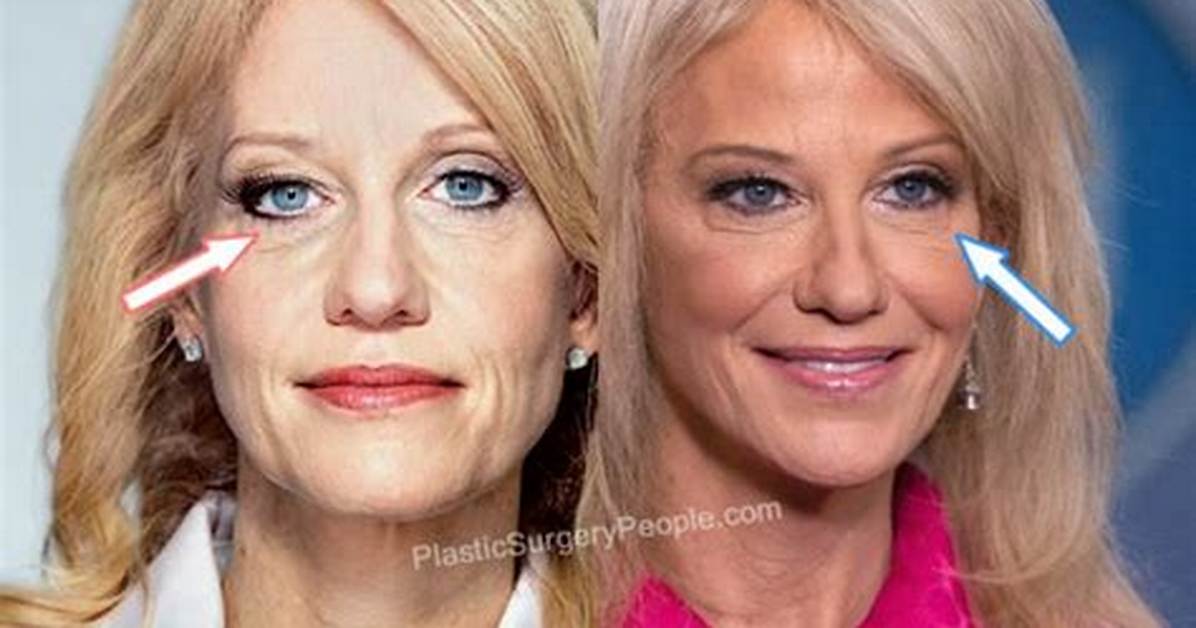Did Kellyanne Conway Get Plastic Surgery? Know Here