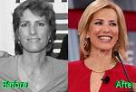 Did Laura Ingraham's Plastic Surgery Transform Her Appearance?