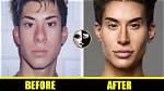 Did Mateo Blanco Have Plastic Surgery? Before and After Photos on Instagram -Details to Know |