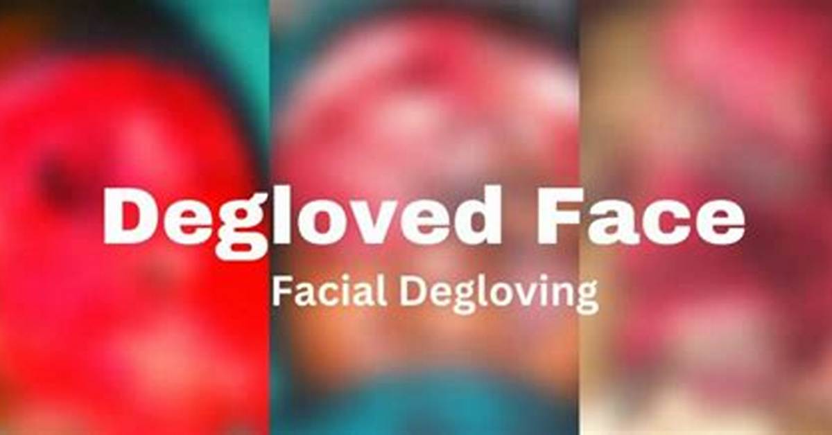 Disturbing Photos of Degloved Faces: a Warning Graphic Image Alert