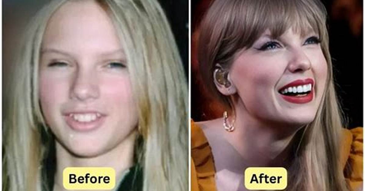Does Taylor Swift Have Fake Teeth? or Did She Get Veneers?