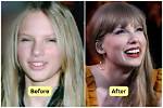 Does Taylor Swift Have Fake Teeth? or Did She Get Veneers?