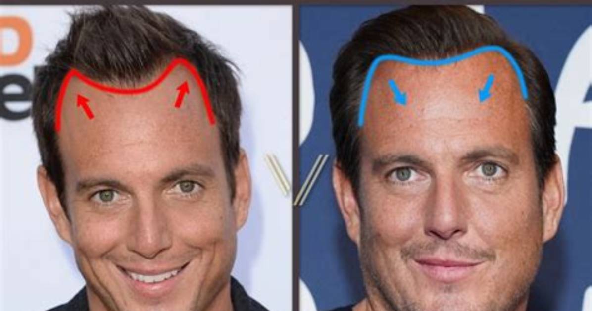 Does Will Arnett Wear a Wig? Murderville Actor Rumored to Have Had an Hair Transplant or Hair Plug-