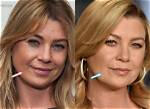 Ellen Pompeo and the Truth Behind Fillers
