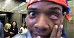Fetty Wap's Left Eye: the Story Behind the Iconic Look