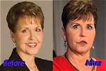Joyce Meyer Plastic Surgery