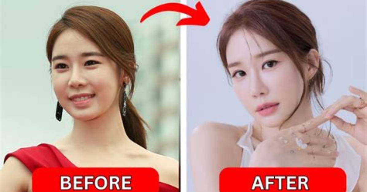 Korean Actor and Actress Plastic Surgery: Unveiling the Transformation