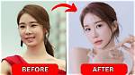 Korean Actor and Actress Plastic Surgery: Unveiling the Transformation