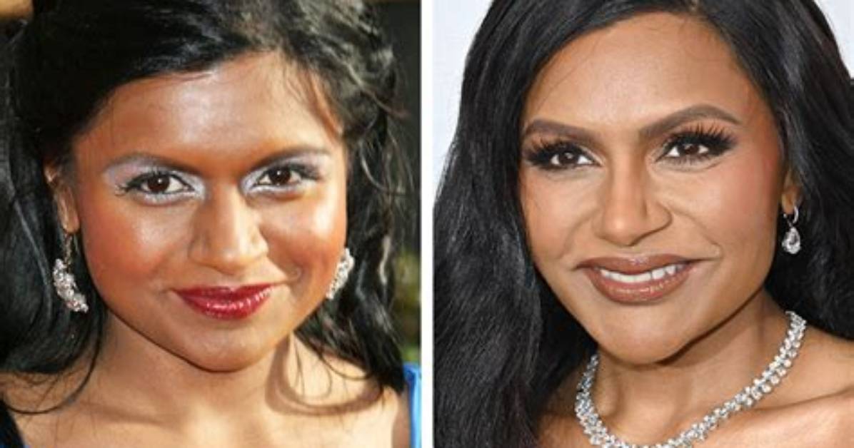 Mindy Kaling Plastic Surgery – Look at Her Before and After Images