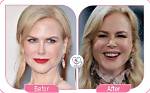 Nicole Kidman Facelift: a Comprehensive Look at Her Transformation and Impact on the Beauty Industry