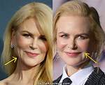 Nicole Kidman's Botox Saga: the Truth Unmasked