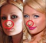Paris Hilton Rhinoplasty Transformation: Before and After