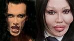 Pete Burns' Cause of Death Explored