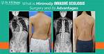 Scoliosis Scar: Understanding Its Significance and Impact