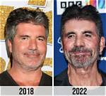 Simon Cowell's Eye Injury: a Closer Look at the Incident and Its Aftermath