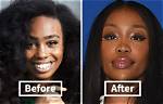Sza's Journey Before Plastic Surgery