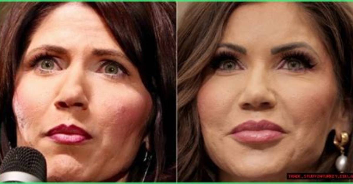 The Ultimate Guide to Kristi Noem Filler: from Procedure to Results