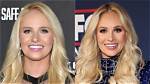 Tomi Lahren's Plastic Surgery Journey