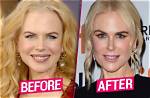 Transformations and Revelations: Nicole Kidman After Plastic Surgery