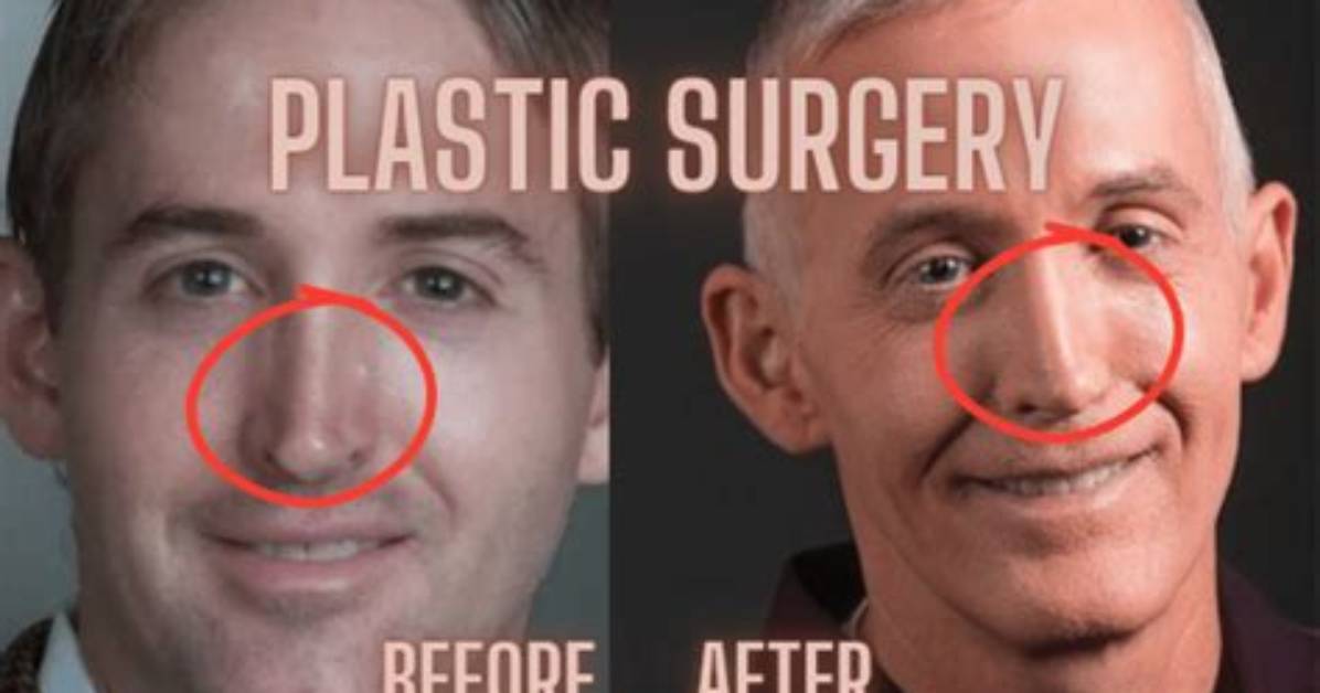 Trey Gowdy Nose Surgery: Understanding the Impact and Changes