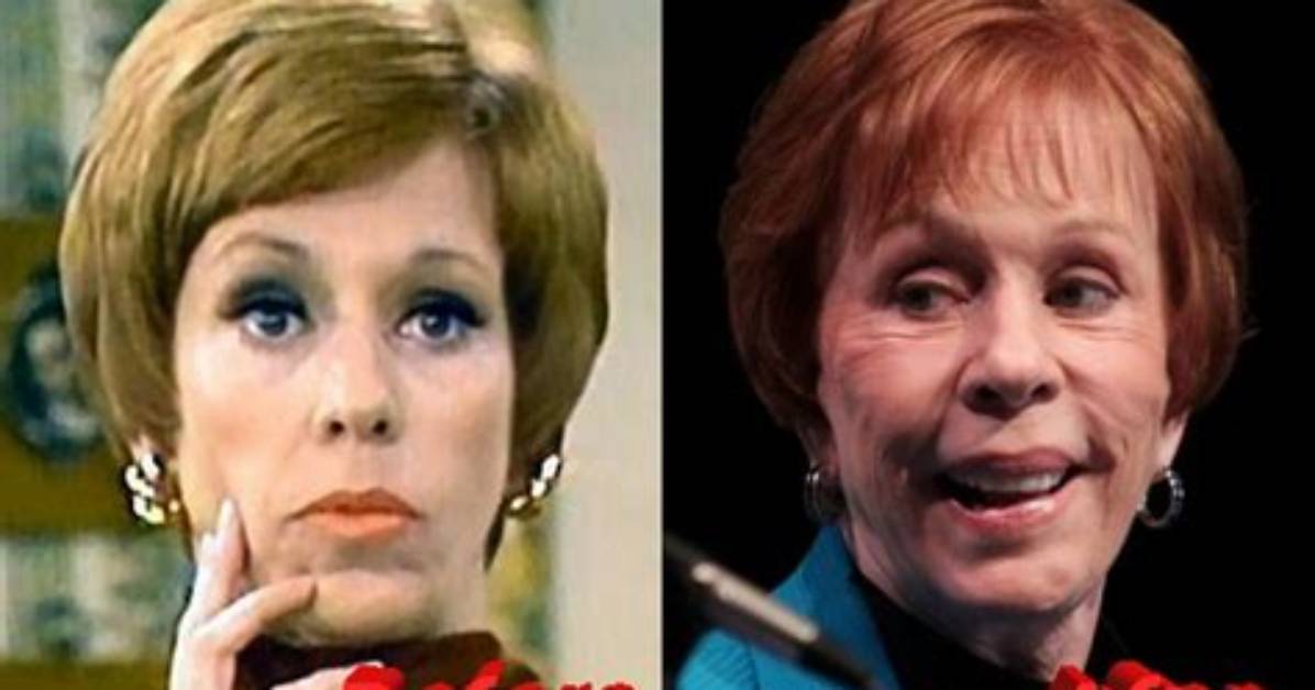 Uncovering Carol Burnett's Plastic Surgery Journey