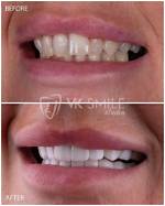 Uncovering the Secrets Behind His Veneers