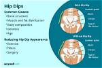 Understanding the Enigma of Hip Dips: What Causes Hip Dips?