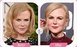 Unmasking Nicole Kidman's Surgery: Before and After Transformations