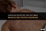 Unraveling the Mystery of Er Zack Measles
