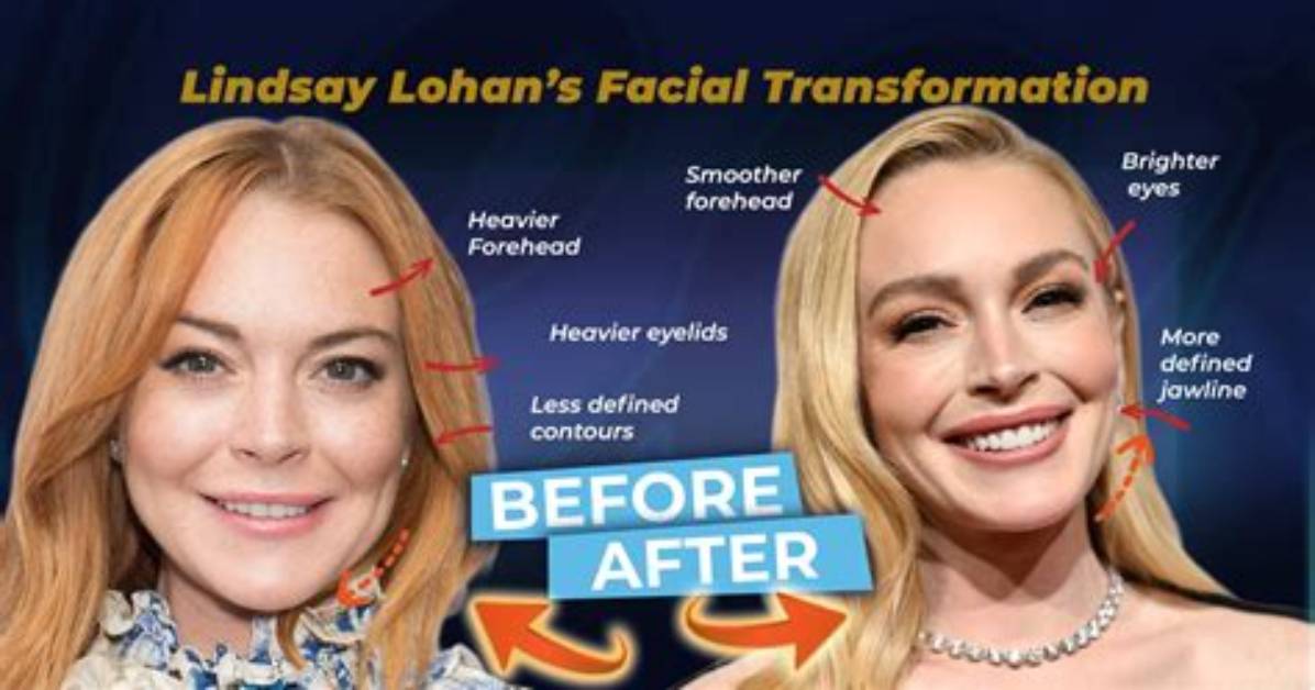 Unveiling Lindsay Lohan's Facelift Journey: Insights and Revelations