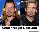 Unveiling the Truth: Did Chad Kroeger Have a Nose Job?